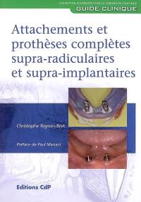 Attachements et prothèses complètes supra-radiculaires et supra-implantaires