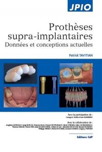 Prothèses supra-implantaires : données et conceptions actuelles