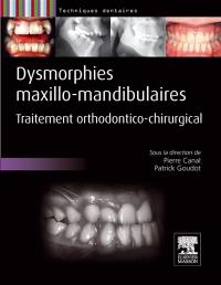 Dysmorphies maxillo-mandibulaires : traitement orthodontico-chirurgical