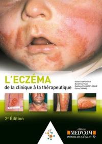 L'eczéma : de la clinique à la thérapeutique