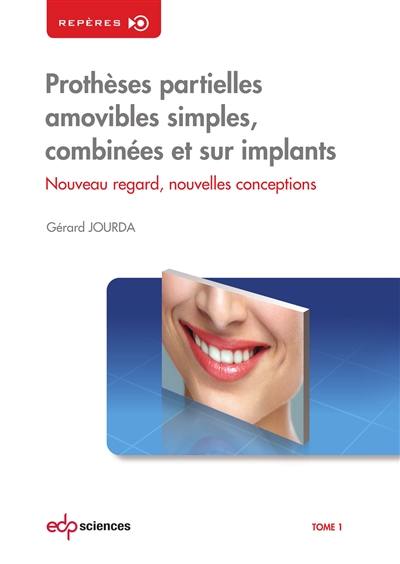 Prothèses partielles amovibles simples, combinées et sur implants : nouveau regard, nouvelles conceptions