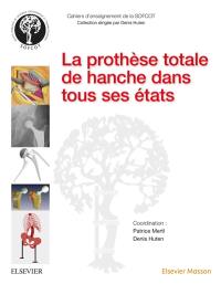 La prothèse totale de hanche dans tous ses états