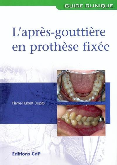 L'après-gouttière en prothèse fixée