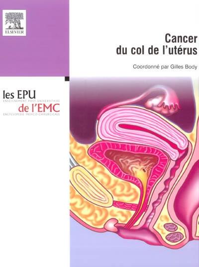 Cancer du col de l'utérus