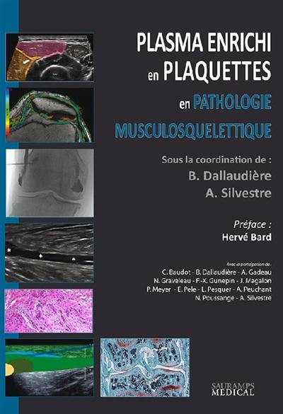 Plasma enrichi en plaquettes en pathologie musculosquelettique