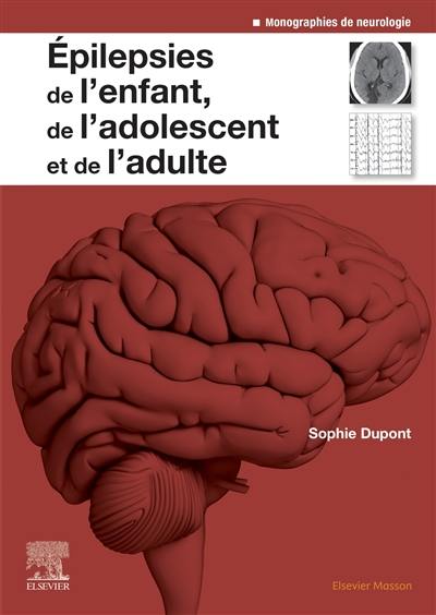 Epilepsies de l'enfant, de l'adolescent et de l'adulte : de la physiopathologie à la prise en charge