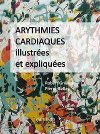 Arythmies cardiaques illustrées et expliquées