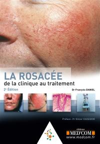 La rosacée : de la clinique au traitement