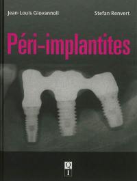 Péri-implantites