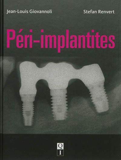 Péri-implantites